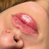 مطب پوست مو تزریق بوتاکس فیلر مزوتراپی هایفو|خدمات آرایشگری و زیبایی|محمدشهر, |دیوار