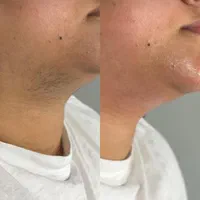 کلینیک لیزر موهای زائد|خدمات آرایشگری و زیبایی|خمینیشهر, |دیوار