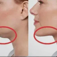 هایفو و ار اف