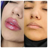 ژل بوتاکس فیلر بادی مزو