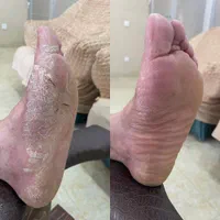 درمان تضمینی پیسی و پسوریازیس|خدمات آرایشگری و زیبایی|مشهد, انقلاب|دیوار