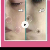 لیزرخال وزگیل منگوله های گوشتی بدون درد