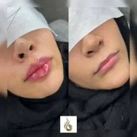 متقاضی مدل فیلر بوتاکس لیفت نخ|خدمات آرایشگری و زیبایی|تهران, دروس|دیوار