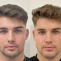 ویژه اقایان آف بوتاکس فیلر و پاکسازی