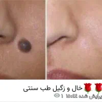 درمان خال زگیل حتی تناسلی در یک جلسه تضمینی