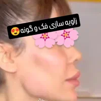 ژل و بوتاکس|خدمات آرایشگری و زیبایی|کرمانشاه, |دیوار