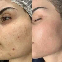 پی ار پی prp صورت/مو/رفع مشکلات پوست|خدمات زیبایی و سلامت|کرمانشاه, |دیوار