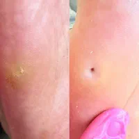 بیماری های ناخن تیرگی قوزک پدیکور آقایان و خانم ها|خدمات آرایشگری و زیبایی|زنجان, |دیوار