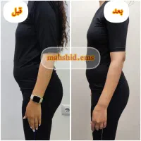 لاغری با ems و عضله سازی و لیفت باسن