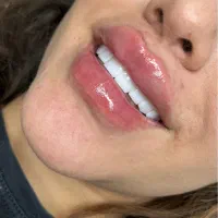 ژل و بوتاکس