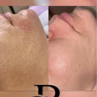 مزوتراپی فیشیال حذف تتو هایفو تضمینی