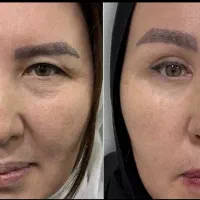بلفاروپلاستی توسط پزشک ۹کاشت ابرو غبغب لابیاپلاستی|خدمات زیبایی و سلامت|تهران, دریا|دیوار
