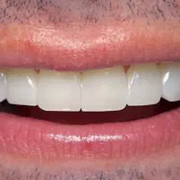 جشنواره‌ی بزرگ کامپوزیت دندان|خدمات آرایشگری و زیبایی|یاسوج, |دیوار