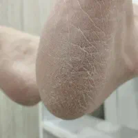 پدیکور وکفسابی پا