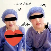 تزریق چربی صورت|خدمات آرایشگری و زیبایی|یاسوج, |دیوار