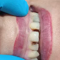 کامپوزیت دندان|خدمات آرایشگری و زیبایی|نورآباد, |دیوار