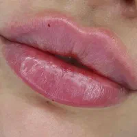 اموزش ژل بوتاکس