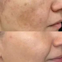 ضدلک لاکچری کوین اصل،کک مک،جای جوش،آفتابسوختگی|آرایشی، بهداشتی، درمانی|اصفهان, بوزان|دیوار