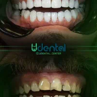 کامپوزیت، لمینت، ایمپلنت اقساط ویژه|خدمات آرایشگری و زیبایی|رشت, ساغری سازان|دیوار