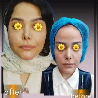 توسط پزشک ژل لب/کانتورینگ/فول فیس/لیفت سه ساله