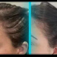 شامپو ضدریز