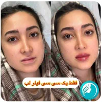 تخفیفات ۵۵٪ دکتر ملائی ،مزو بوتاکس فیلر ژل لب روسی|خدمات آرایشگری و زیبایی|مشهد, سرافرازان|دیوار