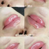 فیلرلب،بوتاکس،مزوژل تزریق توسط پزشک قیمت استثنایی