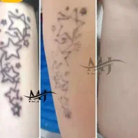 لیزر تتو|خدمات آرایشگری و زیبایی|برازجان, |دیوار