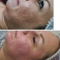 لیزرکیوسوییچ وایتینینگ پاکسازی هالیوودی سفید کننده|خدمات آرایشگری و زیبایی|اسلام‌شهر, زرافشان|دیوار