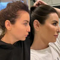 رویش مجدد مو تضمینی و قسطی|آرایشی، بهداشتی، درمانی|رشت, بلوار گیلان|دیوار