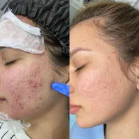 مدل فیشیال ویژه با یکبار فیشیال تغییر رااحساس کنید|خدمات آرایشگری و زیبایی|کرج, گلشهر|دیوار