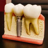 کاشت ایمپلنت (فقط فیکسچر) - ۱۰.۵ میلیون تومان