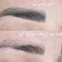 ریموو تتو رفع تیرگی و لک بالیزر در مطب و آموزش|خدمات آرایشگری و زیبایی|اهواز, گلستان|دیوار