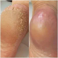 اسپا درمانی کف پا|خدمات آرایشگری و زیبایی|دیلم, |دیوار