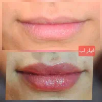 خدمات تخصصی بوتاکس و فیلر در منزل (پزشک مجرب)|خدمات آرایشگری و زیبایی|تهران, اباذر|دیوار
