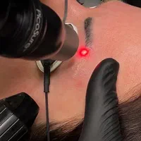 جشنواره یلدایی پاک کردن تتو صورت وبدن بدون آسیب