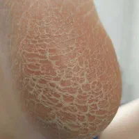 پدیکور کلینیکال درمانی|خدمات آرایشگری و زیبایی|قم, زنبیل آباد|دیوار