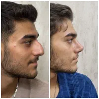 عمل بینی فقط با ۲۰ تومن (تعداد محدود)