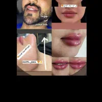 تزریغ فیلر و بوتاکس