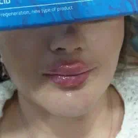 خدمات زیبایی فیلر ،بوتاکس و آنزیم