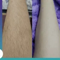 اپیلاسیون ویژه بانوان.موخوره گیری با دستگاه