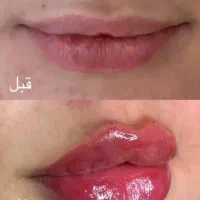 تزریق ژل و بوتاکس با مواد اصل و اورجینال|خدمات آرایشگری و زیبایی|ساری, |دیوار