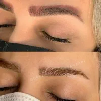 پاک کردن ریموو تتو ابرو و بدن با لیزر توسط پزشک