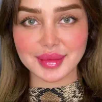 تزریق ژل وبوتاکس وچربی 100%