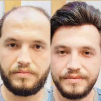 چسب پروتز مو/تعویض چسب