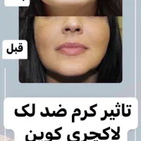 تنها نمایندگی کرم ضد لک لاکچری کوین(اصلی)|آرایشی، بهداشتی، درمانی|مشهد, توس (بلوار توس)|دیوار