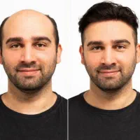 کاشت مو/کاشت ابرو/کاشت ریش/بالاترین تراکم/تضمینی|خدمات آرایشگری و زیبایی|مشهد, سجاد شهر|دیوار