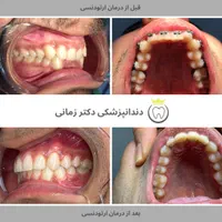 ارتودنسی نامرئی به روش دیجیتالی