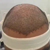 جشنواره ۷ ملیونی کاشت مو /بانوان و اقایان|خدمات آرایشگری و زیبایی|شیراز, قصرالدشت|دیوار