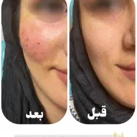 جشنواره تزریق ژل ۳۸۰ هزاروبوتاکس توسط کادردرمان|خدمات آرایشگری و زیبایی|اندیمشک, |دیوار